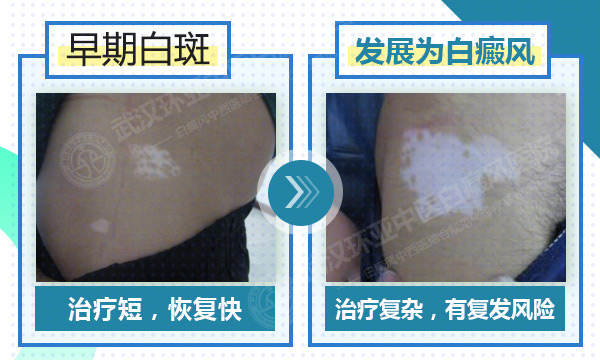 41-辨别皮肤白斑的早期症状.jpg